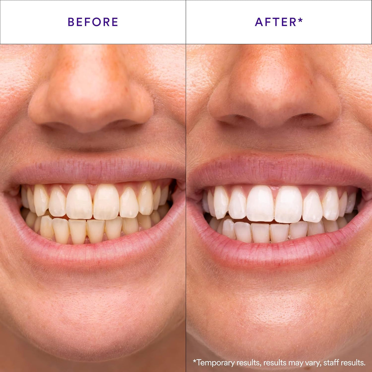 V34 Purple Teeth Whitening Strips, 14 Count, Peroxide-Free, Brightens Teeth in 30 Minutes, Combines Whitening and Colour Correction