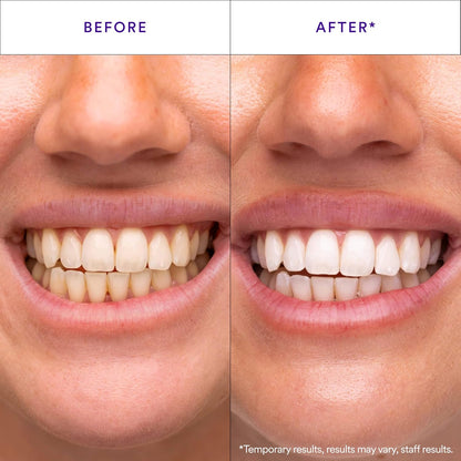 V34 Purple Teeth Whitening Strips, 14 Count, Peroxide-Free, Brightens Teeth in 30 Minutes, Combines Whitening and Colour Correction